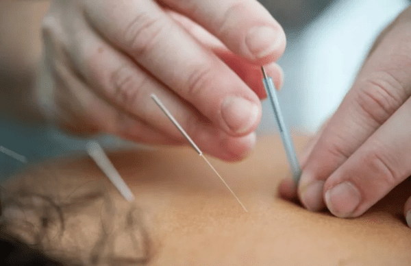 akupunktura medyczna krakow kurs
