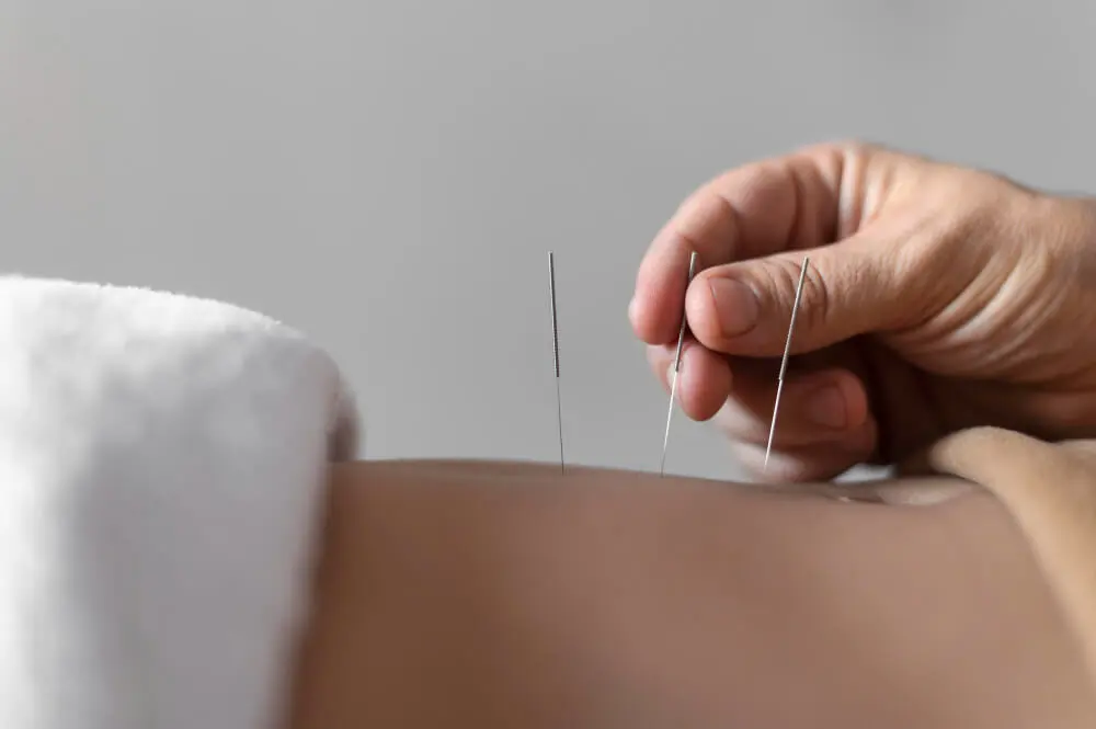 Igłowanie a akupunktura
